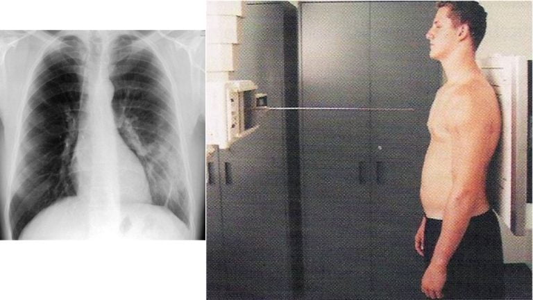 Imagem de um exame de radiografia de tórax na incidência antero posterior (AP). À esquerda, a radiografia mostra uma visão detalhada dos pulmões e do coração, capturada de frente para trás. À direita, um homem está posicionado de frente para a máquina de raios X, com o peito voltado para o detector, demonstrando a técnica de incidência AP.