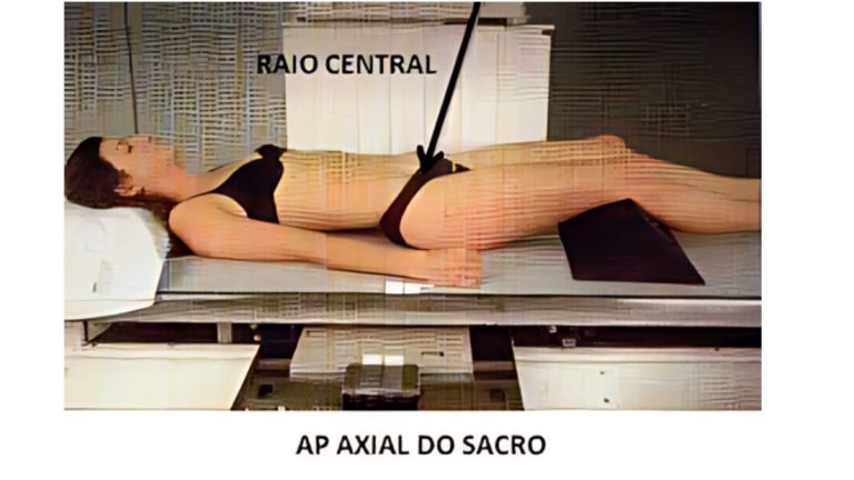 Imagem mostrando a posição de uma paciente deitada para uma radiografia na incidência axial anteroposterior (AP) do sacro. A paciente está deitada de costas, com as pernas estendidas e ligeiramente elevadas por um suporte. A linha do raio central está indicada na imagem, mostrando a direção do feixe de raios-X em relação ao corpo da paciente.